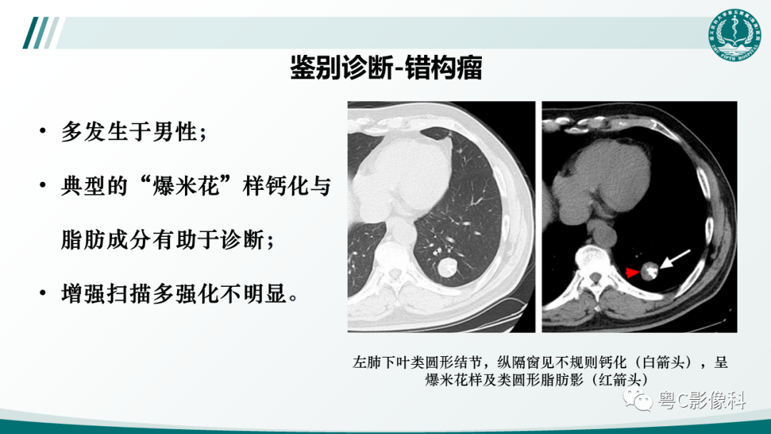 影像PPT - 【PPT】肺良性血管周上皮样细胞肿瘤影像诊断-28