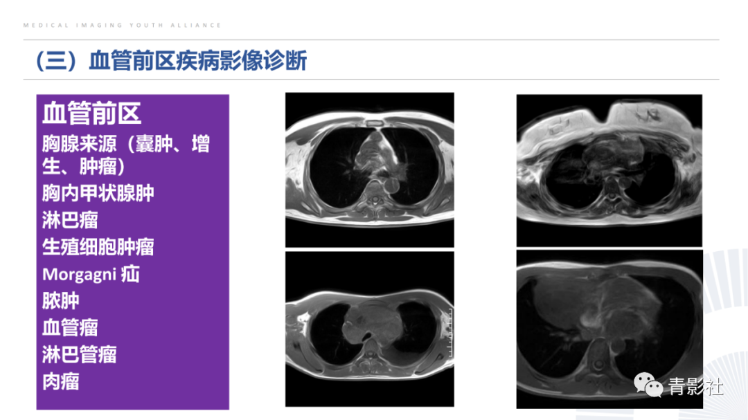 影像PPT - 【PPT】纵隔血管前区疾病的影像诊断思路-10