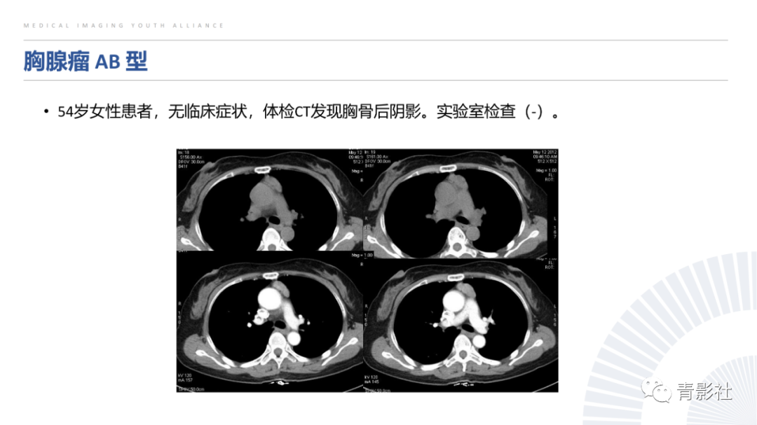 影像PPT - 【PPT】纵隔血管前区疾病的影像诊断思路-13
