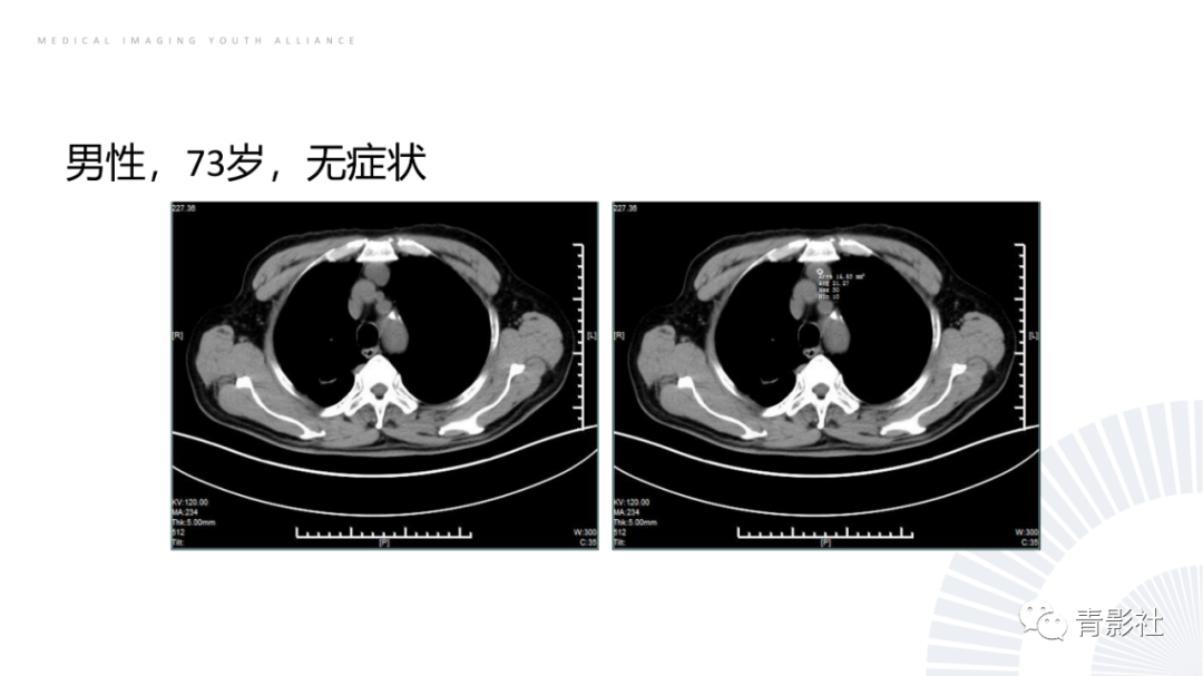 影像PPT - 【PPT】纵隔血管前区疾病的影像诊断思路-14