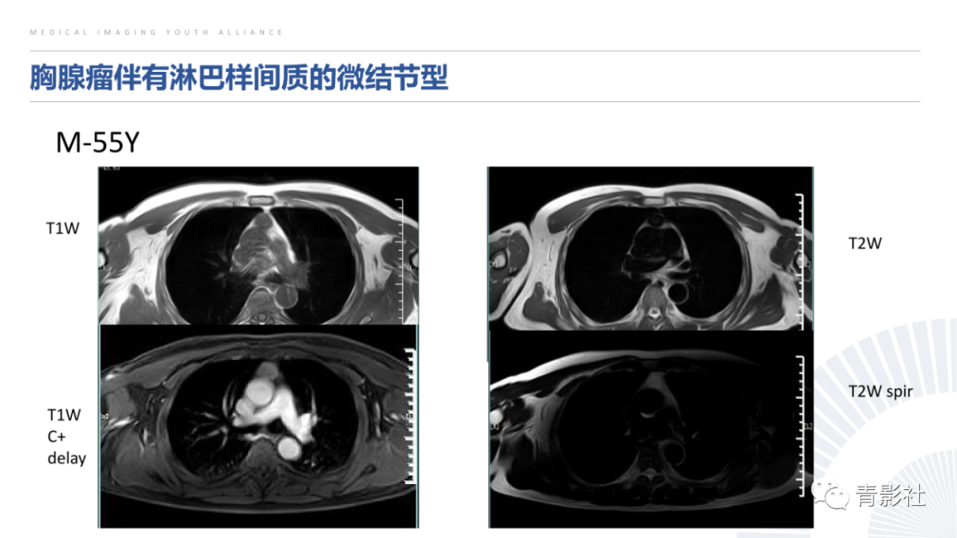 影像PPT - 【PPT】纵隔血管前区疾病的影像诊断思路-19