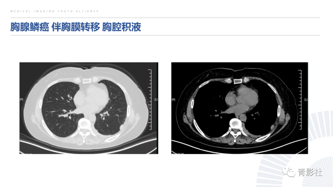 影像PPT - 【PPT】纵隔血管前区疾病的影像诊断思路-22