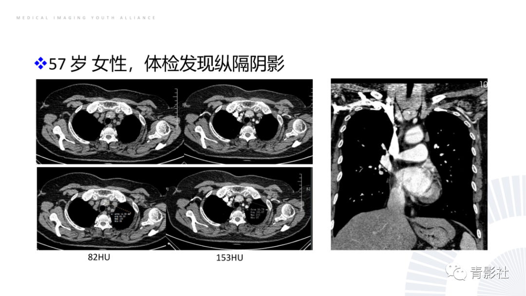 影像PPT - 【PPT】纵隔血管前区疾病的影像诊断思路-29