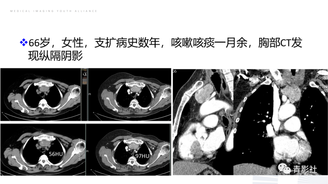 影像PPT - 【PPT】纵隔血管前区疾病的影像诊断思路-30