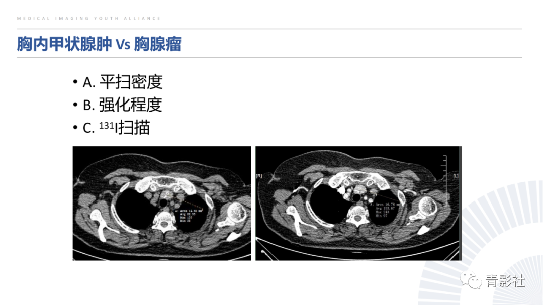影像PPT - 【PPT】纵隔血管前区疾病的影像诊断思路-32