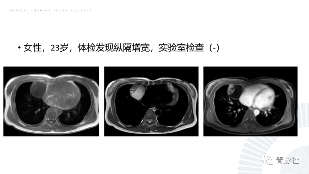 影像PPT - 【PPT】纵隔血管前区疾病的影像诊断思路-38