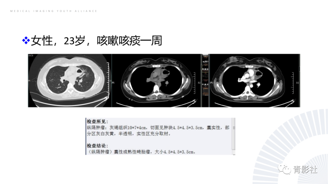 影像PPT - 【PPT】纵隔血管前区疾病的影像诊断思路-40