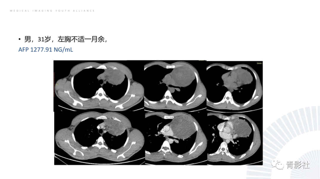影像PPT - 【PPT】纵隔血管前区疾病的影像诊断思路-41