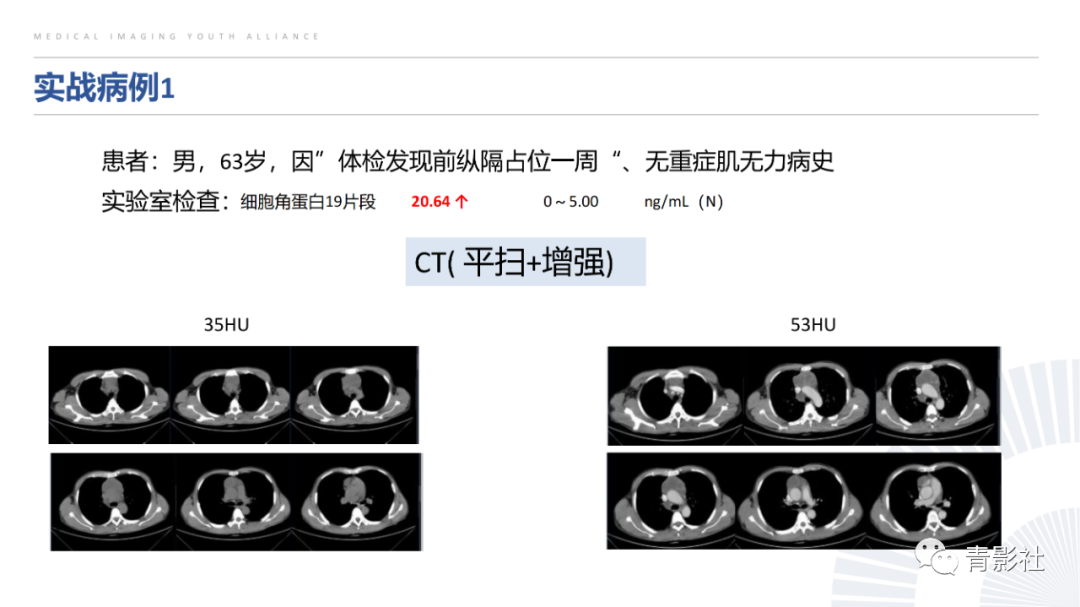 影像PPT - 【PPT】纵隔血管前区疾病的影像诊断思路-49