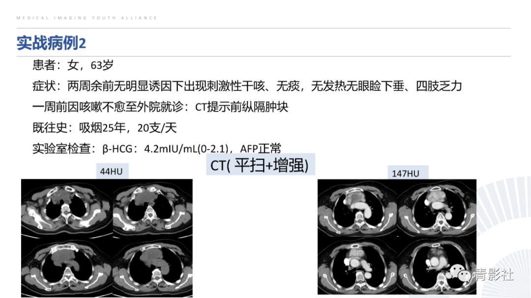 影像PPT - 【PPT】纵隔血管前区疾病的影像诊断思路-52