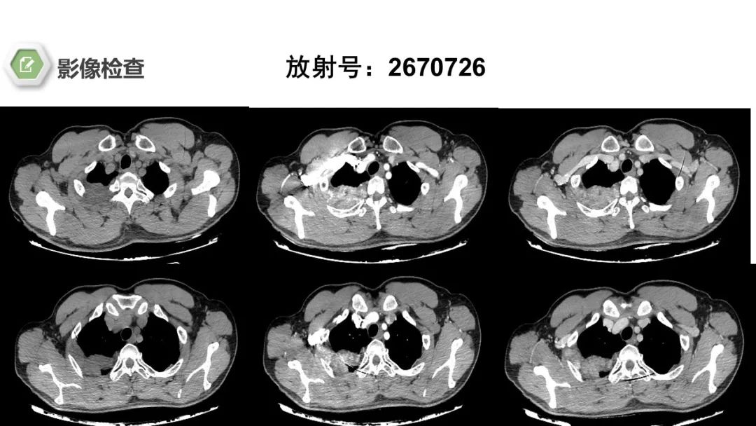 影像PPT - 【病例】胸膜中间型血管瘤1例CT影像-4 影像PPT - 【病例】胸膜中间型血管瘤1例CT影像-4