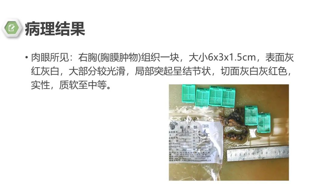 影像PPT - 【病例】胸膜中间型血管瘤1例CT影像-8 影像PPT - 【病例】胸膜中间型血管瘤1例CT影像-8