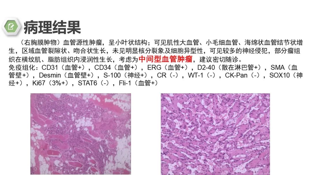 影像PPT - 【病例】胸膜中间型血管瘤1例CT影像-9 影像PPT - 【病例】胸膜中间型血管瘤1例CT影像-9