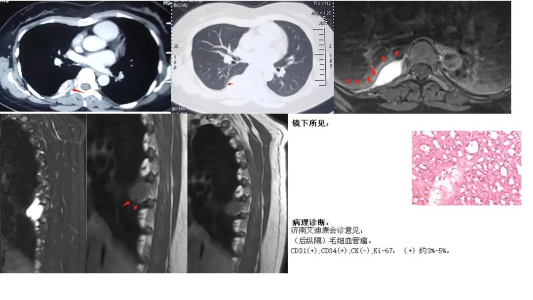 影像PPT - 【病例】胸膜中间型血管瘤1例CT影像-12 影像PPT - 【病例】胸膜中间型血管瘤1例CT影像-12
