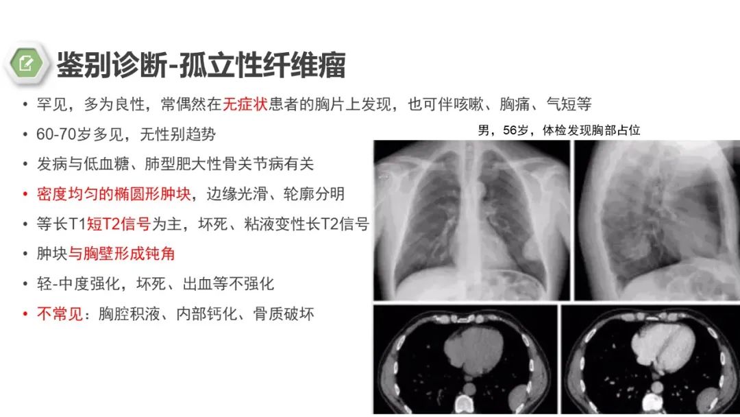影像PPT - 【病例】胸膜中间型血管瘤1例CT影像-14 影像PPT - 【病例】胸膜中间型血管瘤1例CT影像-14