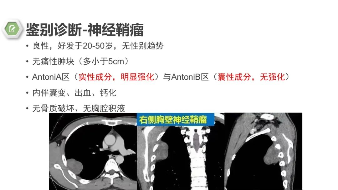 影像PPT - 【病例】胸膜中间型血管瘤1例CT影像-15 影像PPT - 【病例】胸膜中间型血管瘤1例CT影像-15