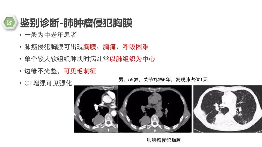 影像PPT - 【病例】胸膜中间型血管瘤1例CT影像-16 影像PPT - 【病例】胸膜中间型血管瘤1例CT影像-16