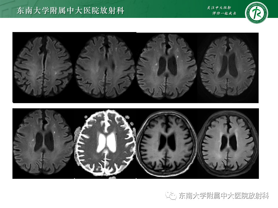 影像PPT - 【PPT】非对称、多灶性脑白质受累为主病例随访-2