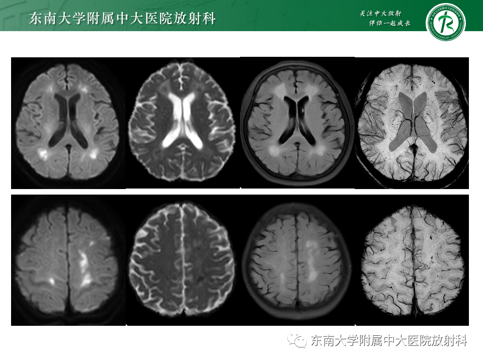 影像PPT - 【PPT】非对称、多灶性脑白质受累为主病例随访-5