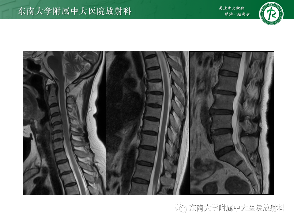 影像PPT - 【PPT】非对称、多灶性脑白质受累为主病例随访-6