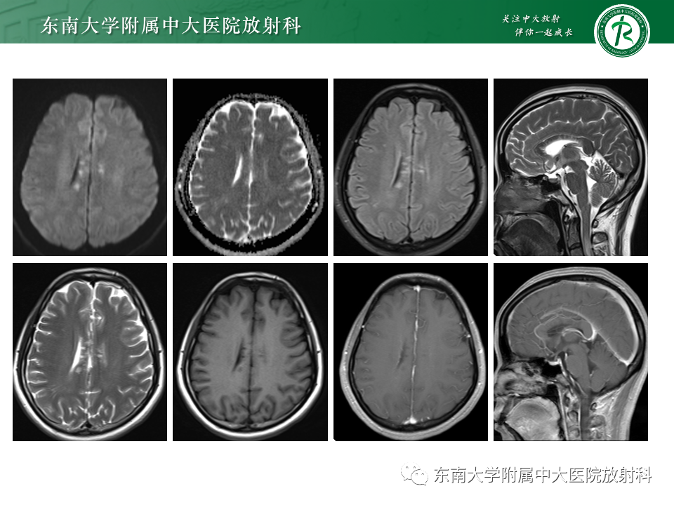 影像PPT - 【PPT】非对称、多灶性脑白质受累为主病例随访-9