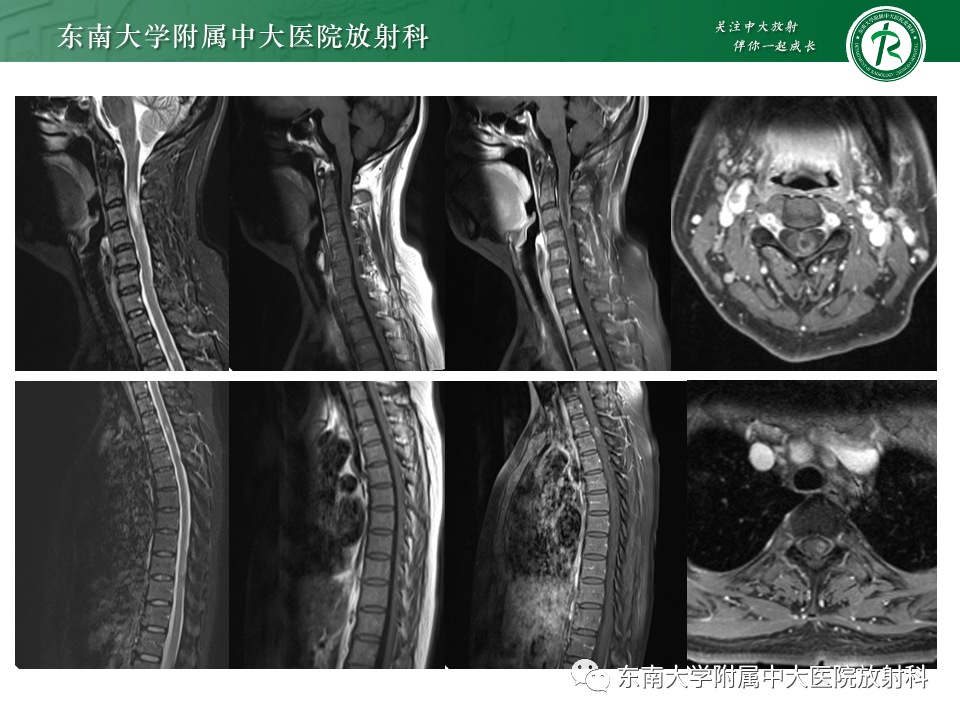影像PPT - 【PPT】非对称、多灶性脑白质受累为主病例随访-10