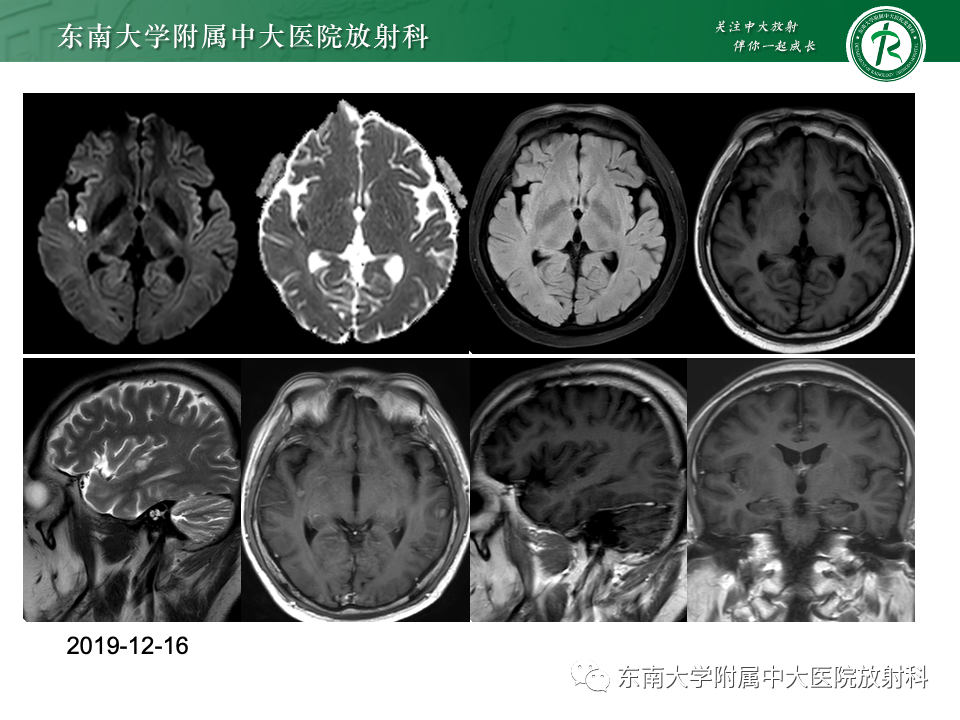 影像PPT - 【PPT】非对称、多灶性脑白质受累为主病例随访-13