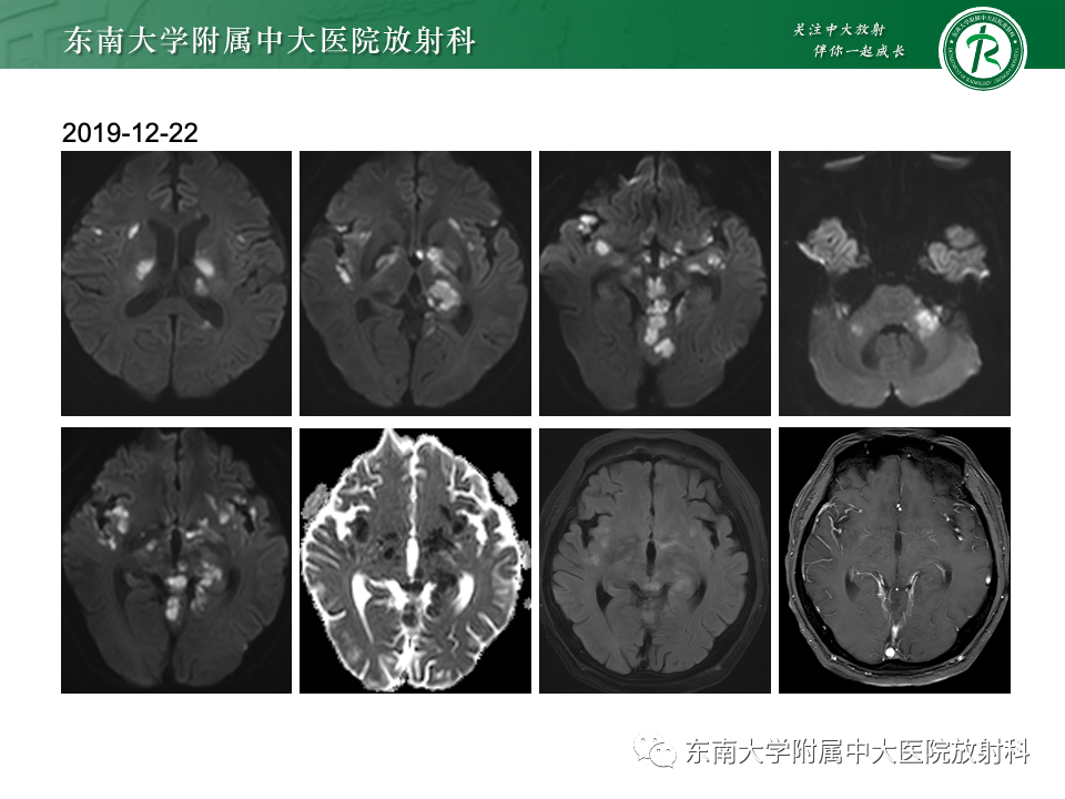 影像PPT - 【PPT】非对称、多灶性脑白质受累为主病例随访-15