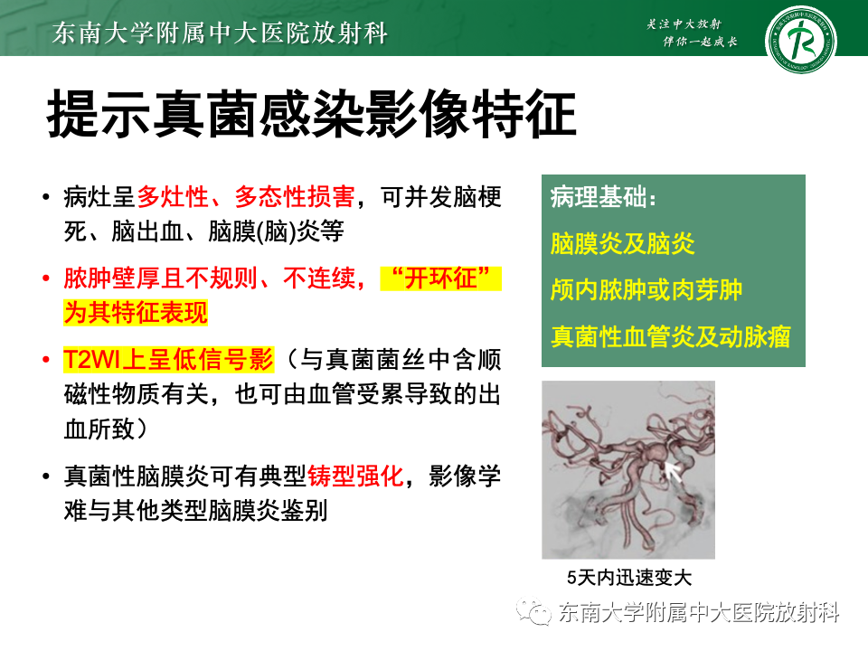 影像PPT - 【PPT】非对称、多灶性脑白质受累为主病例随访-26