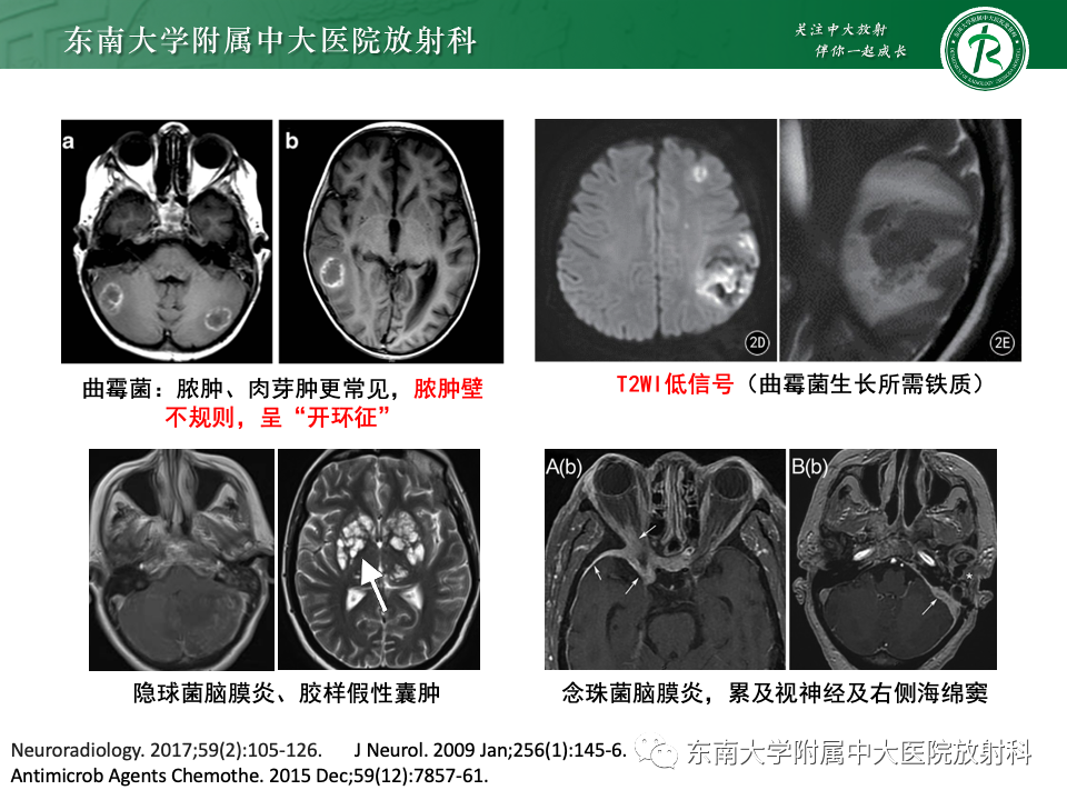 影像PPT - 【PPT】非对称、多灶性脑白质受累为主病例随访-27