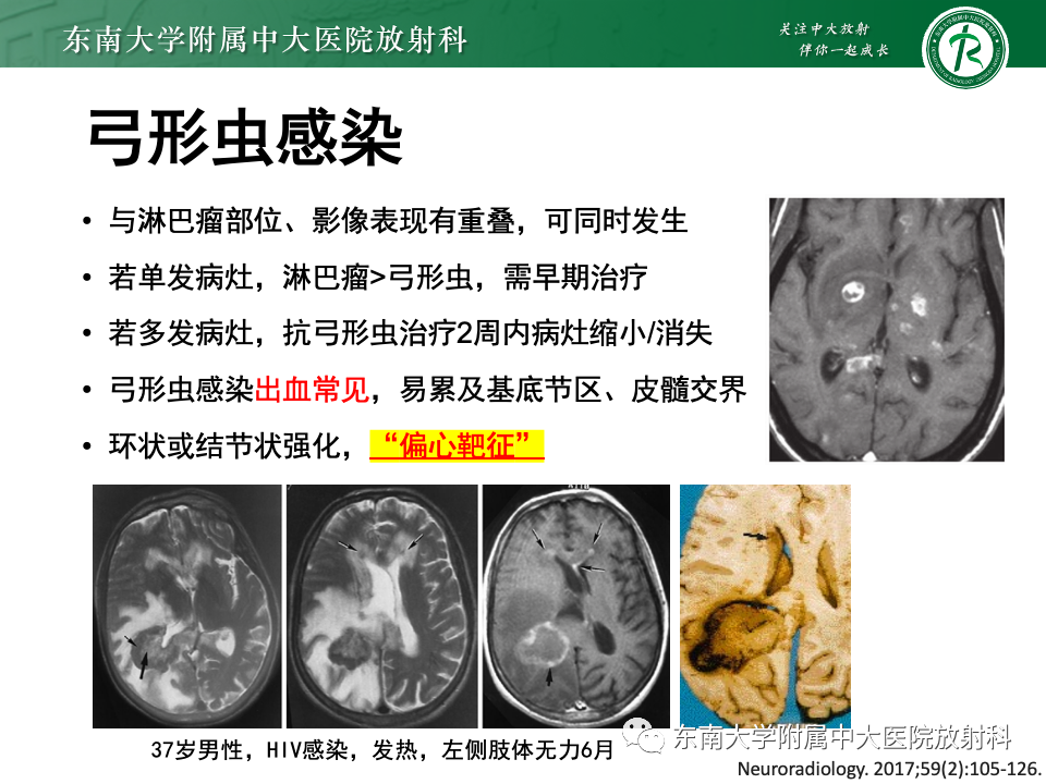 影像PPT - 【PPT】非对称、多灶性脑白质受累为主病例随访-28