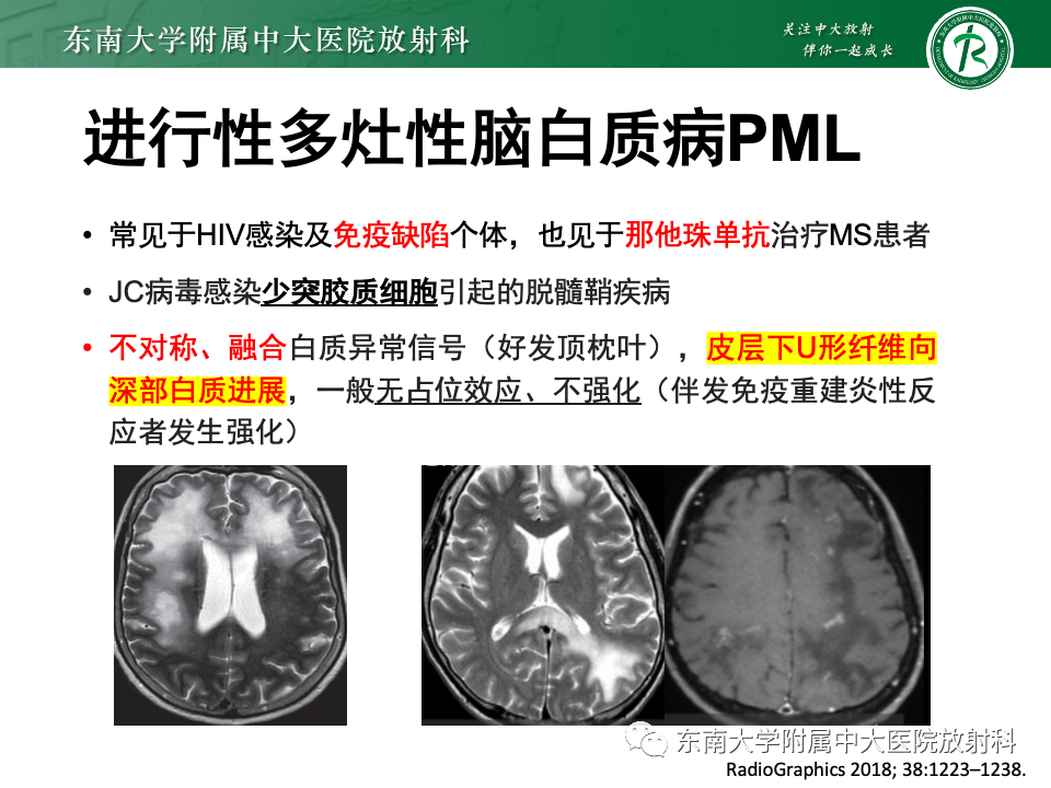 影像PPT - 【PPT】非对称、多灶性脑白质受累为主病例随访-29
