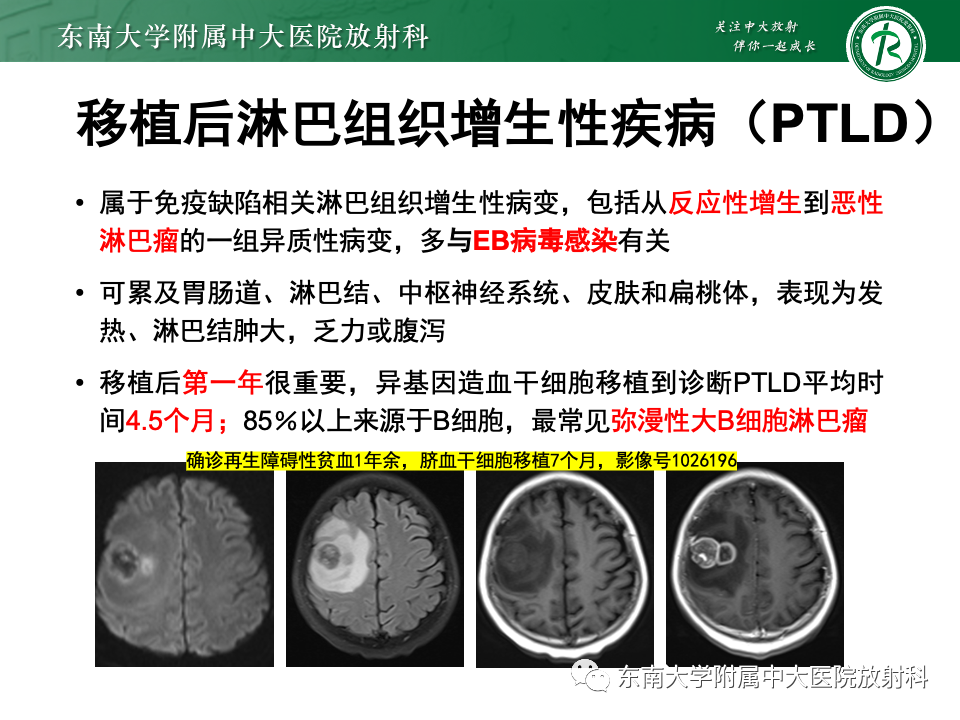 影像PPT - 【PPT】非对称、多灶性脑白质受累为主病例随访-31