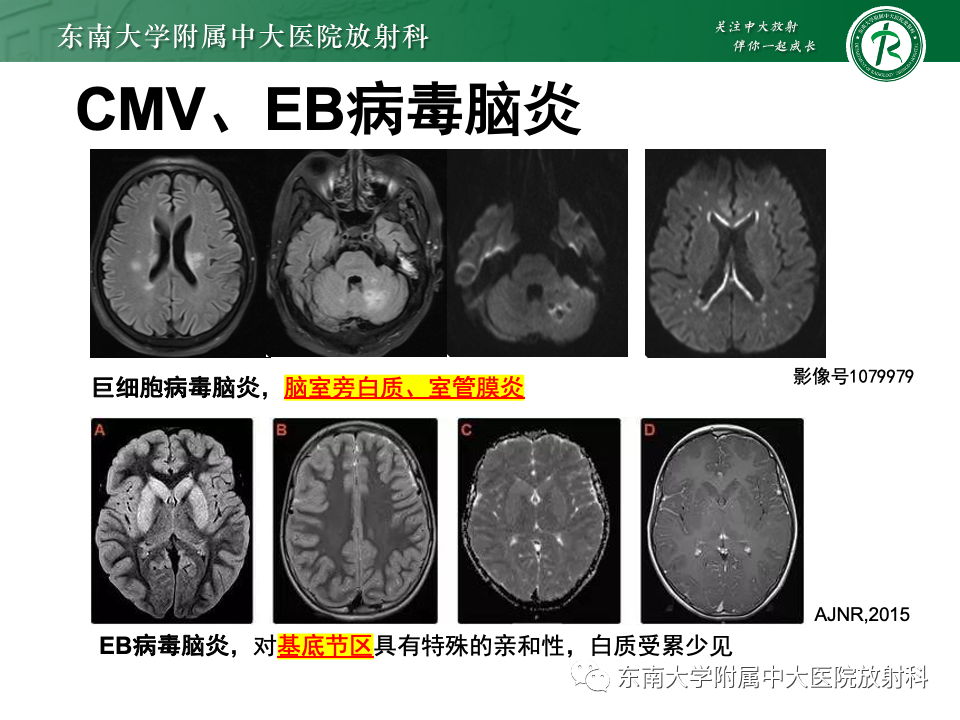 影像PPT - 【PPT】非对称、多灶性脑白质受累为主病例随访-30