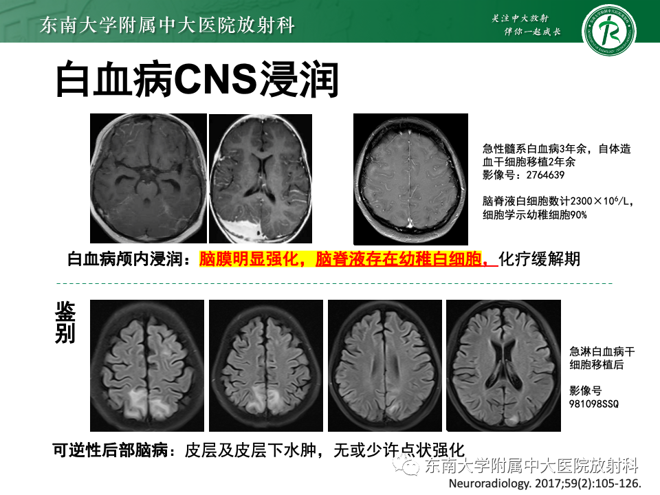 影像PPT - 【PPT】非对称、多灶性脑白质受累为主病例随访-32