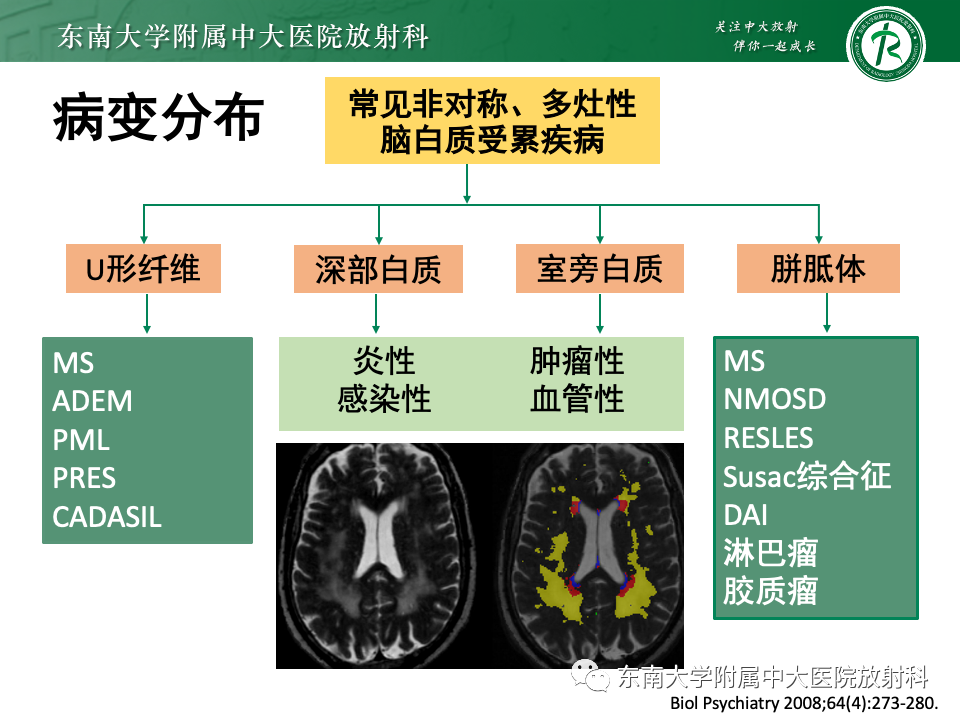 影像PPT - 【PPT】非对称、多灶性脑白质受累为主病例随访-33