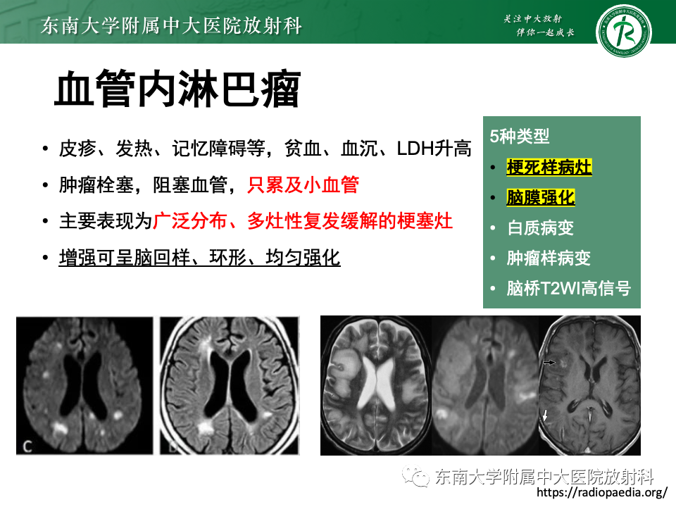 影像PPT - 【PPT】非对称、多灶性脑白质受累为主病例随访-42
