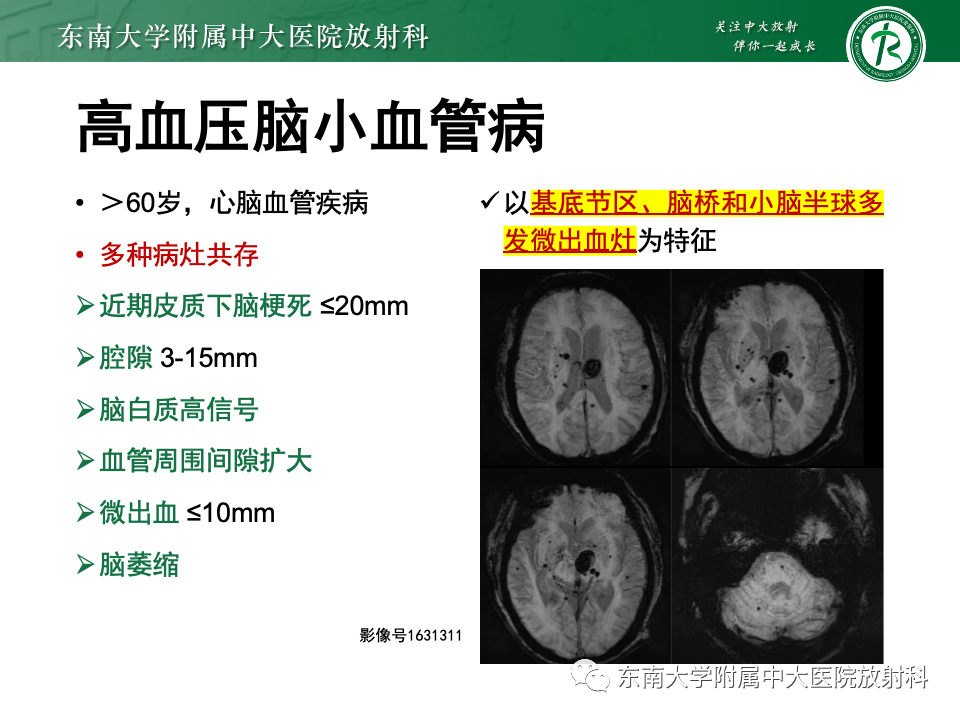 影像PPT - 【PPT】非对称、多灶性脑白质受累为主病例随访-45
