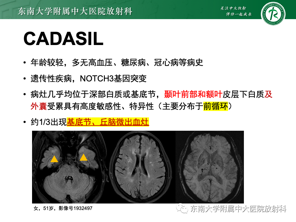 影像PPT - 【PPT】非对称、多灶性脑白质受累为主病例随访-47