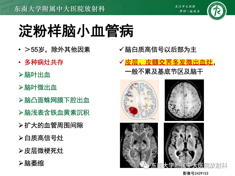 影像PPT - 【PPT】非对称、多灶性脑白质受累为主病例随访-46