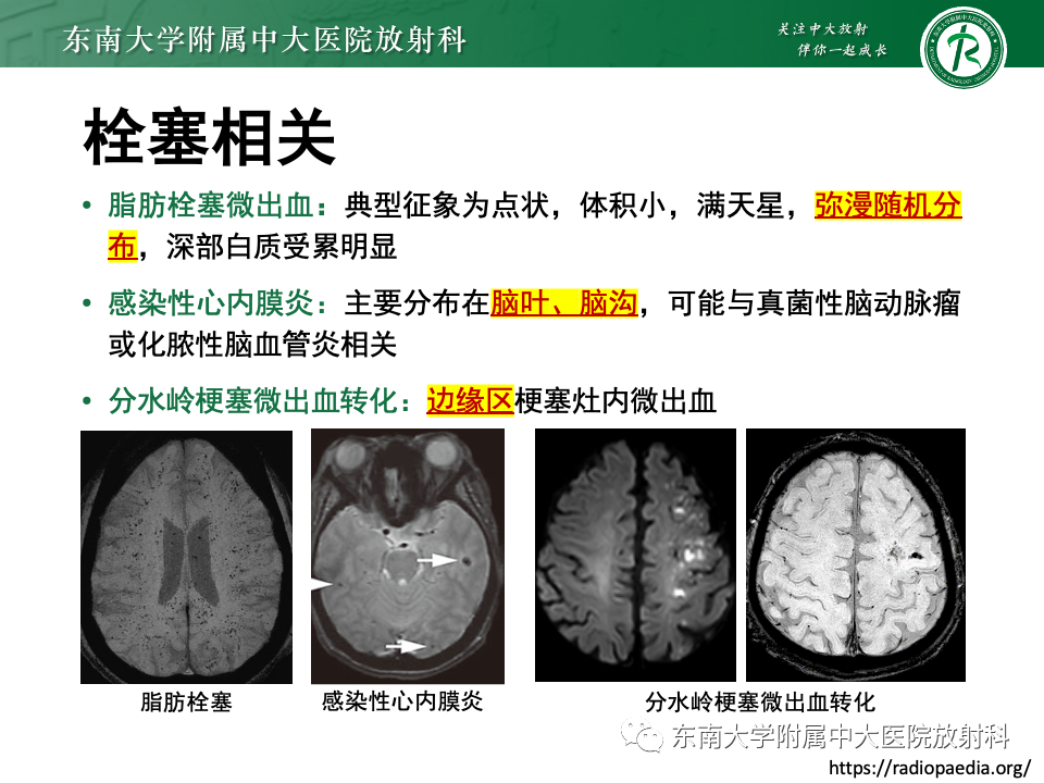 影像PPT - 【PPT】非对称、多灶性脑白质受累为主病例随访-49