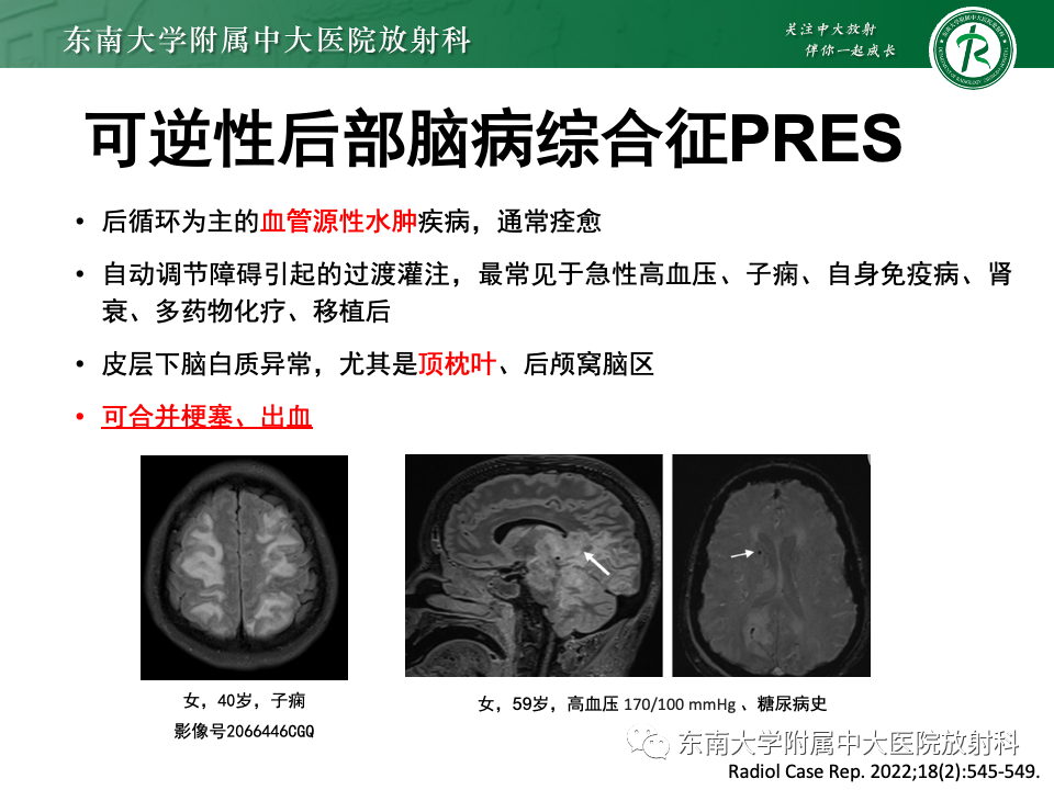 影像PPT - 【PPT】非对称、多灶性脑白质受累为主病例随访-50