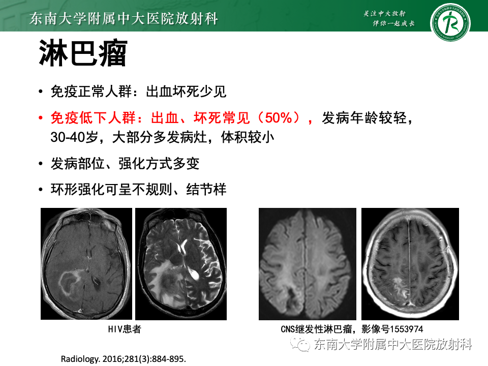 影像PPT - 【PPT】非对称、多灶性脑白质受累为主病例随访-51
