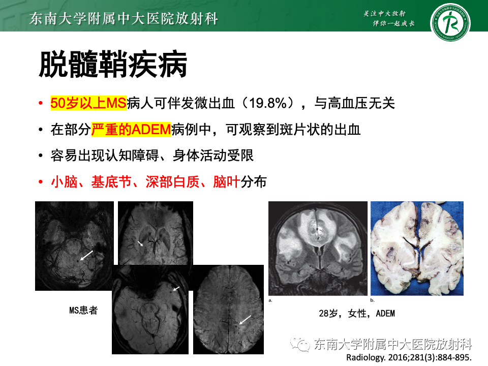 影像PPT - 【PPT】非对称、多灶性脑白质受累为主病例随访-52
