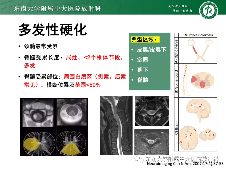 影像PPT - 【PPT】非对称、多灶性脑白质受累为主病例随访-55