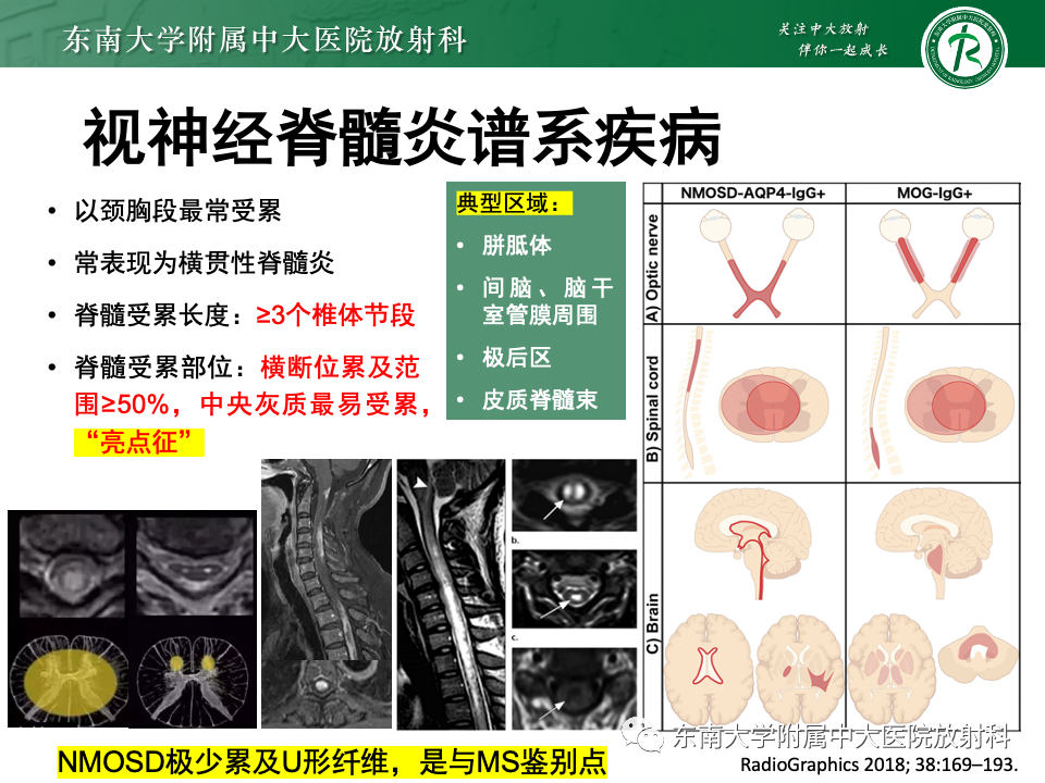 影像PPT - 【PPT】非对称、多灶性脑白质受累为主病例随访-56