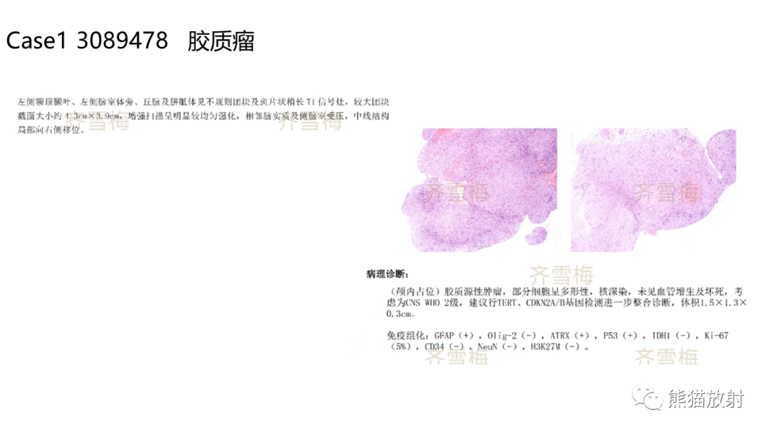 影像PPT - 【病例】胶质瘤 VS 淋巴瘤-17