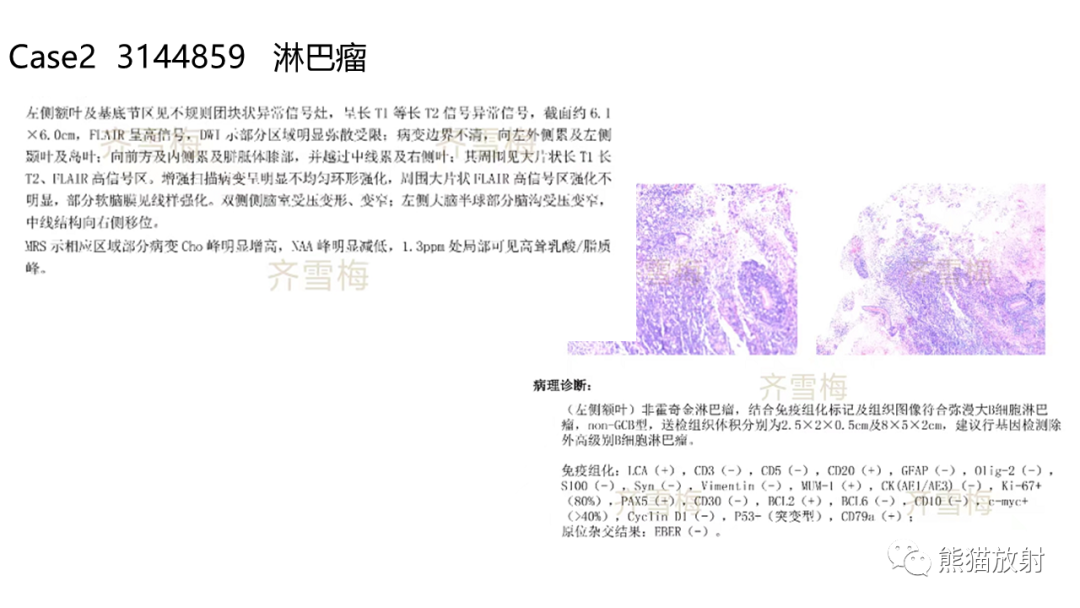 影像PPT - 【病例】胶质瘤 VS 淋巴瘤-18
