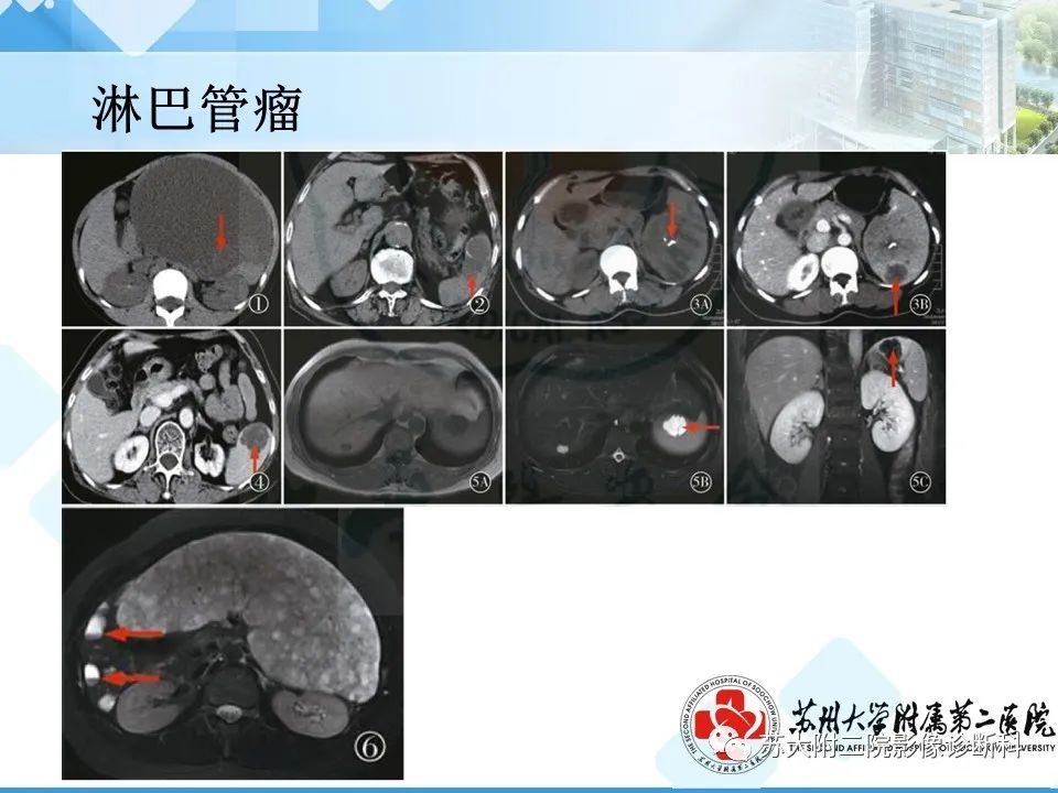 影像PPT - 【PPT】脾脏囊状淋巴管瘤 & 窦岸细胞血管瘤 & 硬化性血管瘤样结节转化-12