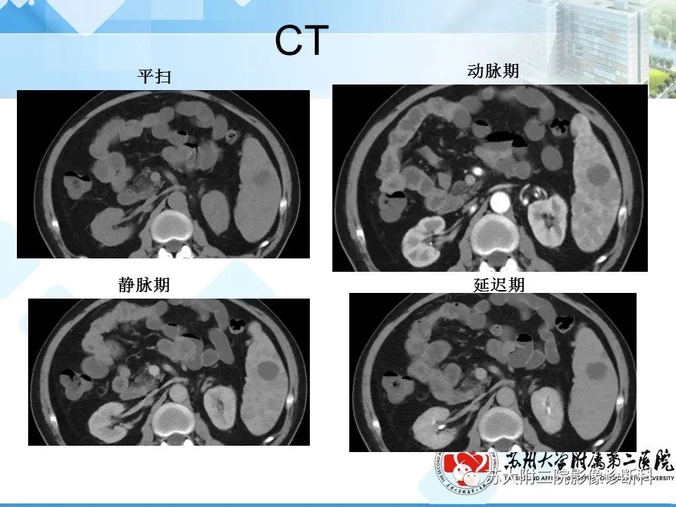 影像PPT - 【PPT】脾脏囊状淋巴管瘤 & 窦岸细胞血管瘤 & 硬化性血管瘤样结节转化-15